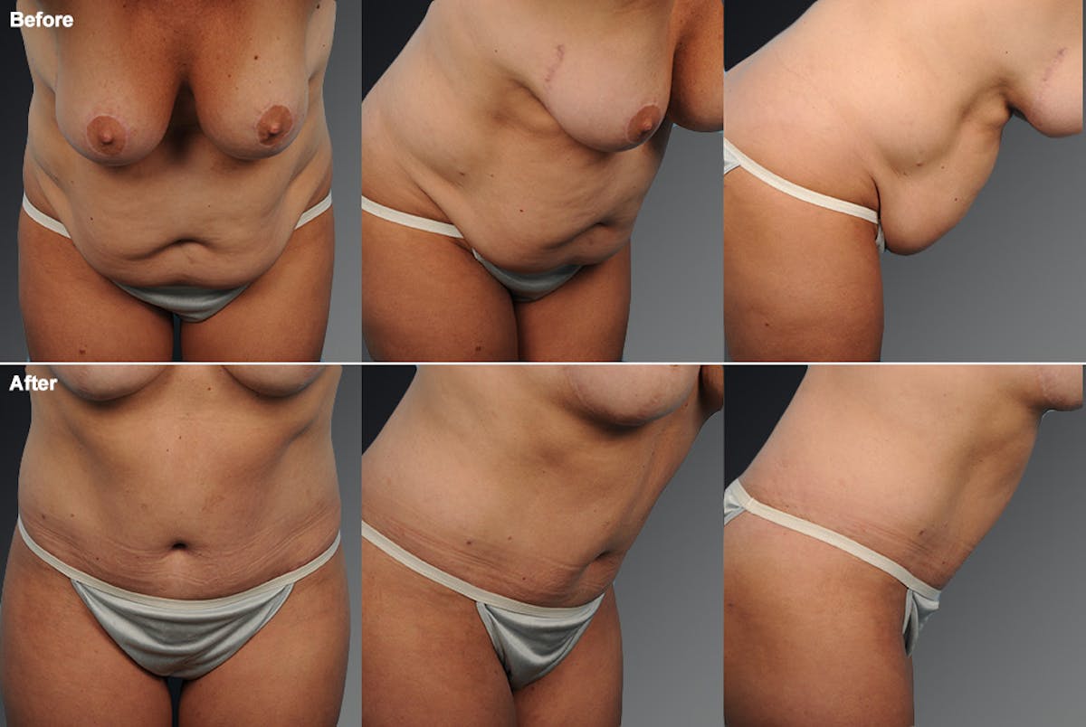 Tummy Tuck Before & After Gallery - Patient 105840720 - Image 1