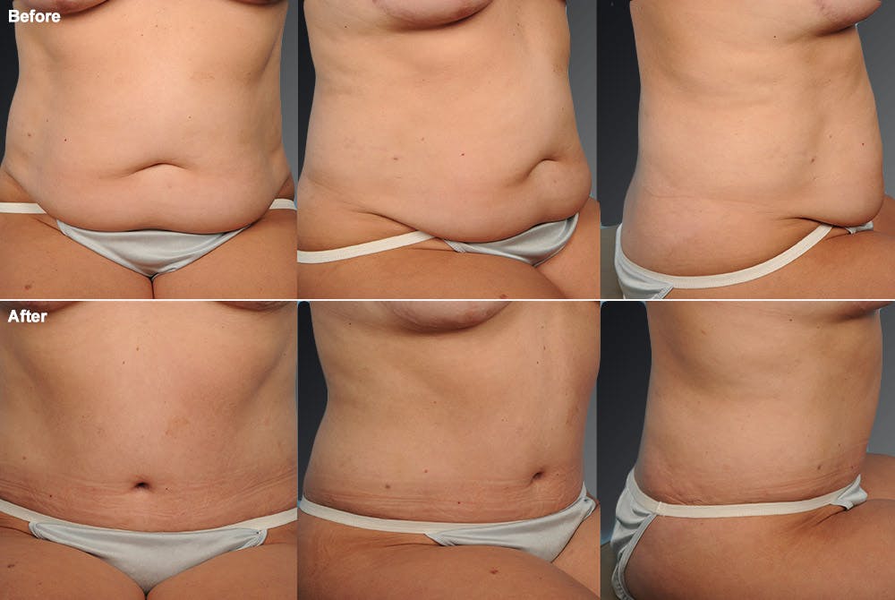 Tummy Tuck Before & After Gallery - Patient 105840721 - Image 1