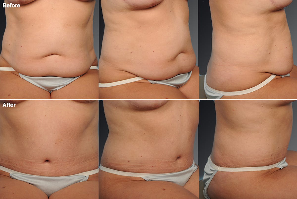 Tummy Tuck Before & After Gallery - Patient 105840721 - Image 1