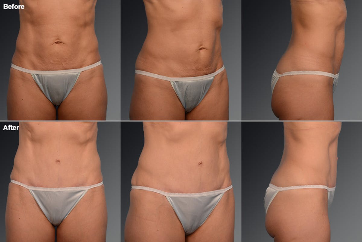 Tummy Tuck Before & After Gallery - Patient 105840722 - Image 1