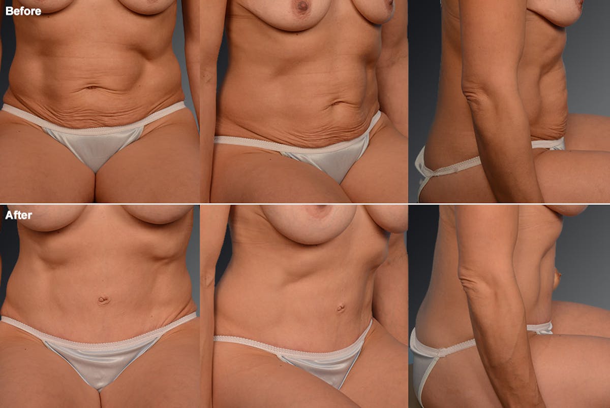 Tummy Tuck Before & After Gallery - Patient 105840723 - Image 1
