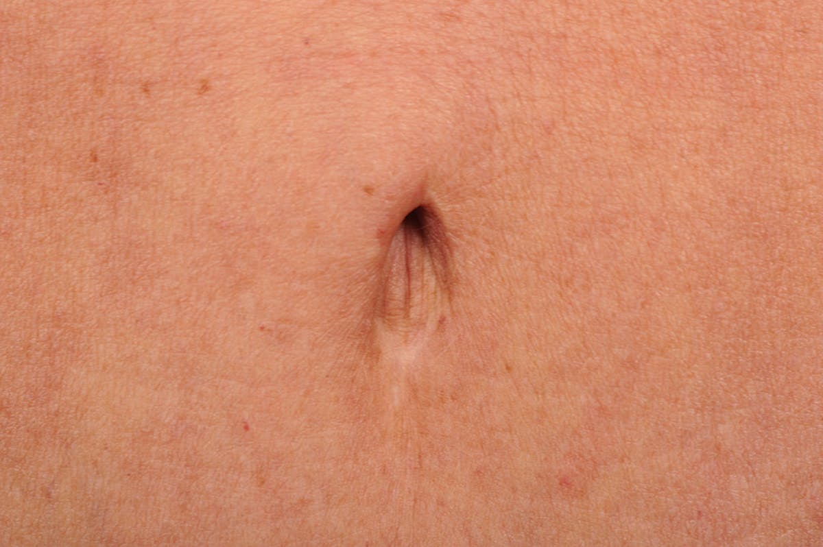 Tummy Tuck Before & After Gallery - Patient 105840724 - Image 1