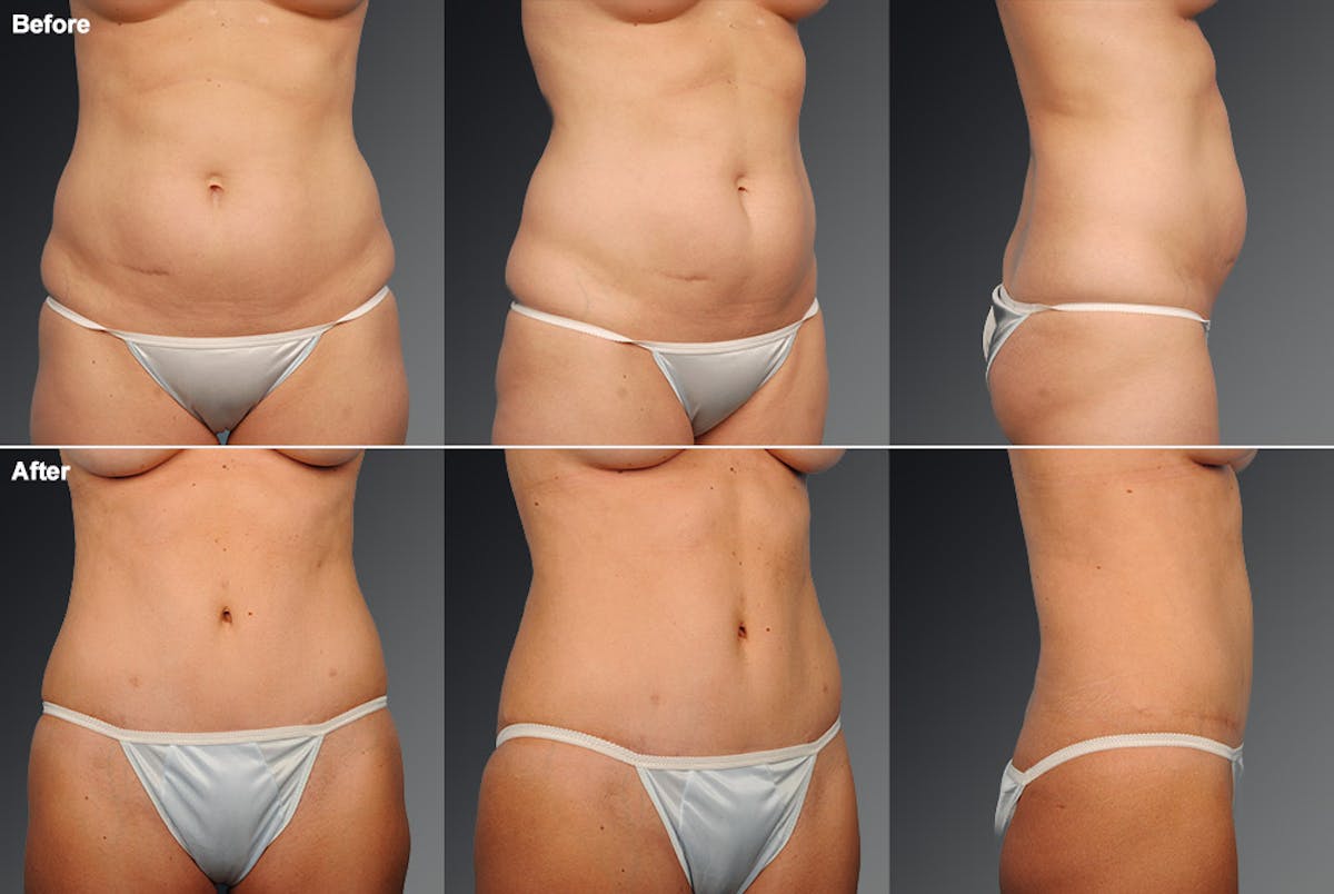 Tummy Tuck Before & After Gallery - Patient 105840725 - Image 1