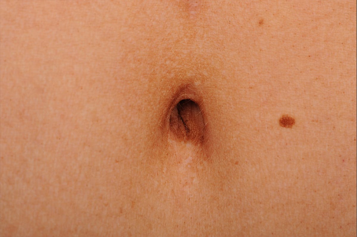 Tummy Tuck Before & After Gallery - Patient 105840726 - Image 1