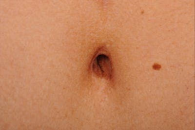 Tummy Tuck Before & After Gallery - Patient 105840726 - Image 1
