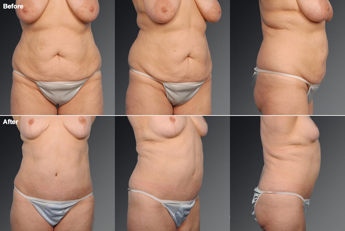 Tummy Tuck Before & After Gallery - Patient 105840729 - Image 1