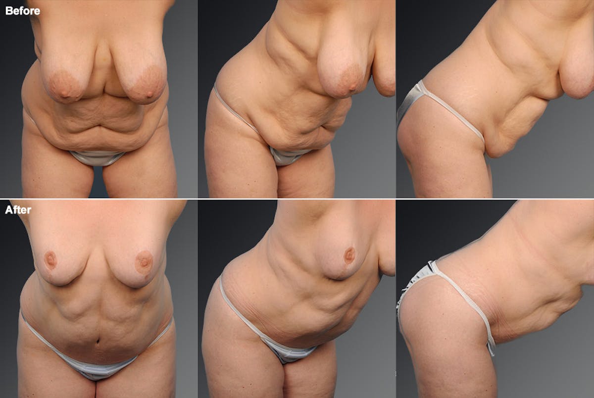 Tummy Tuck Before & After Gallery - Patient 105840730 - Image 1