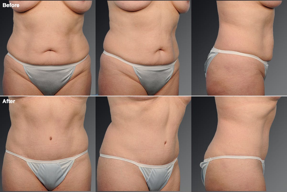 Tummy Tuck Before & After Gallery - Patient 105840731 - Image 1