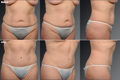 Tummy Tuck Before & After Gallery - Patient 105840731 - Image 1