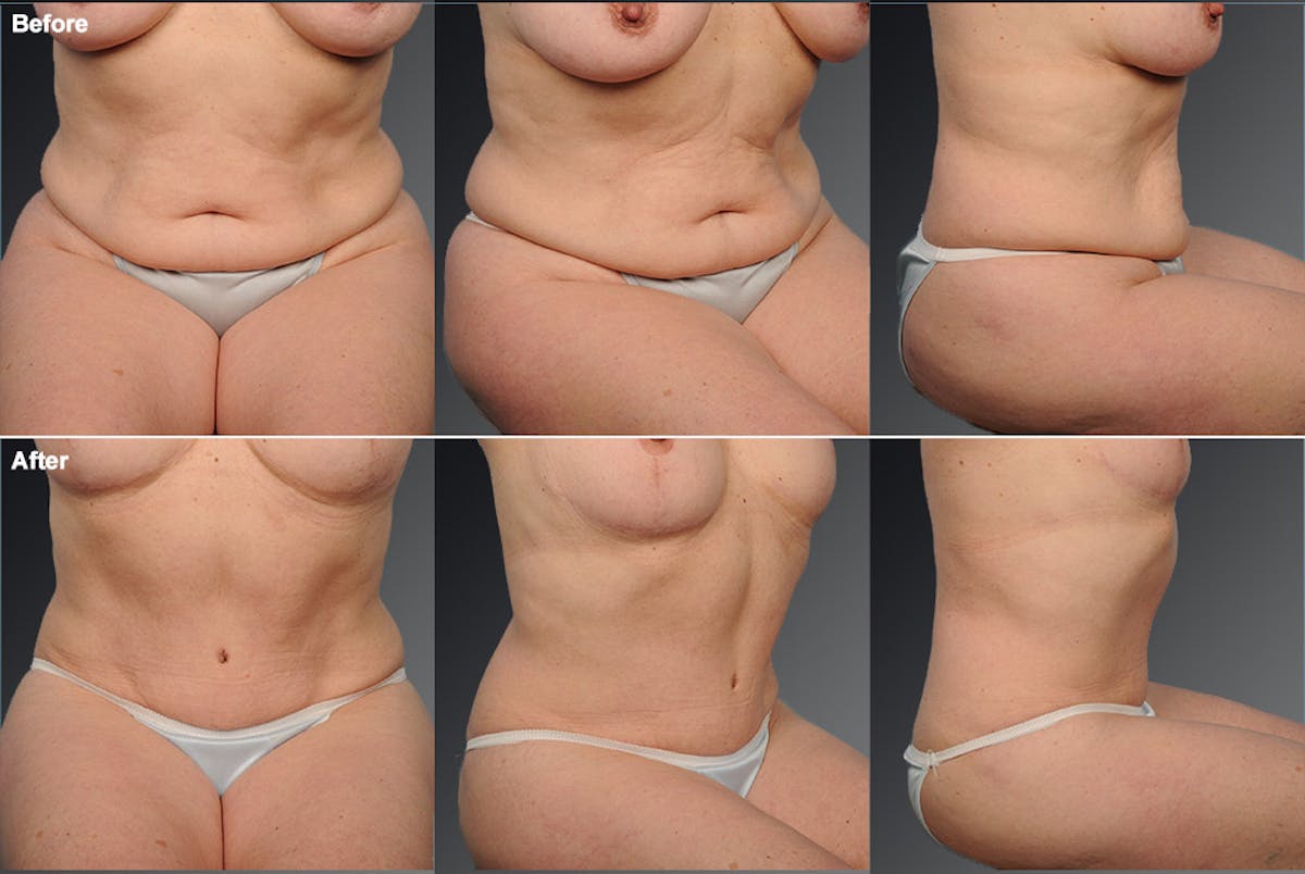 Tummy Tuck Before & After Gallery - Patient 105840734 - Image 1