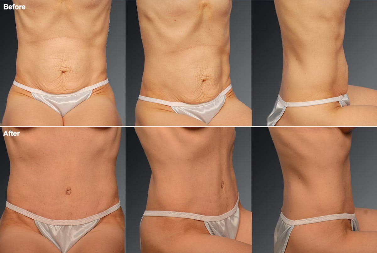 Tummy Tuck Before & After Gallery - Patient 105840735 - Image 1
