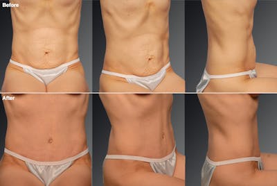 Tummy Tuck Before & After Gallery - Patient 105840735 - Image 1
