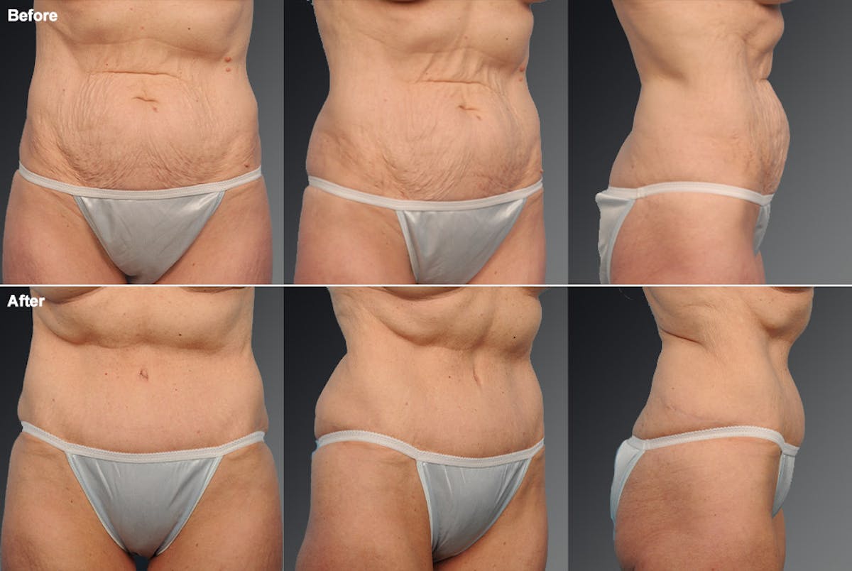 Tummy Tuck Before & After Gallery - Patient 105840736 - Image 1