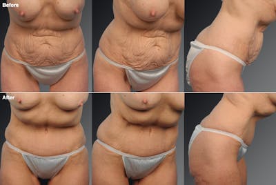 Tummy Tuck Before & After Gallery - Patient 105840738 - Image 1