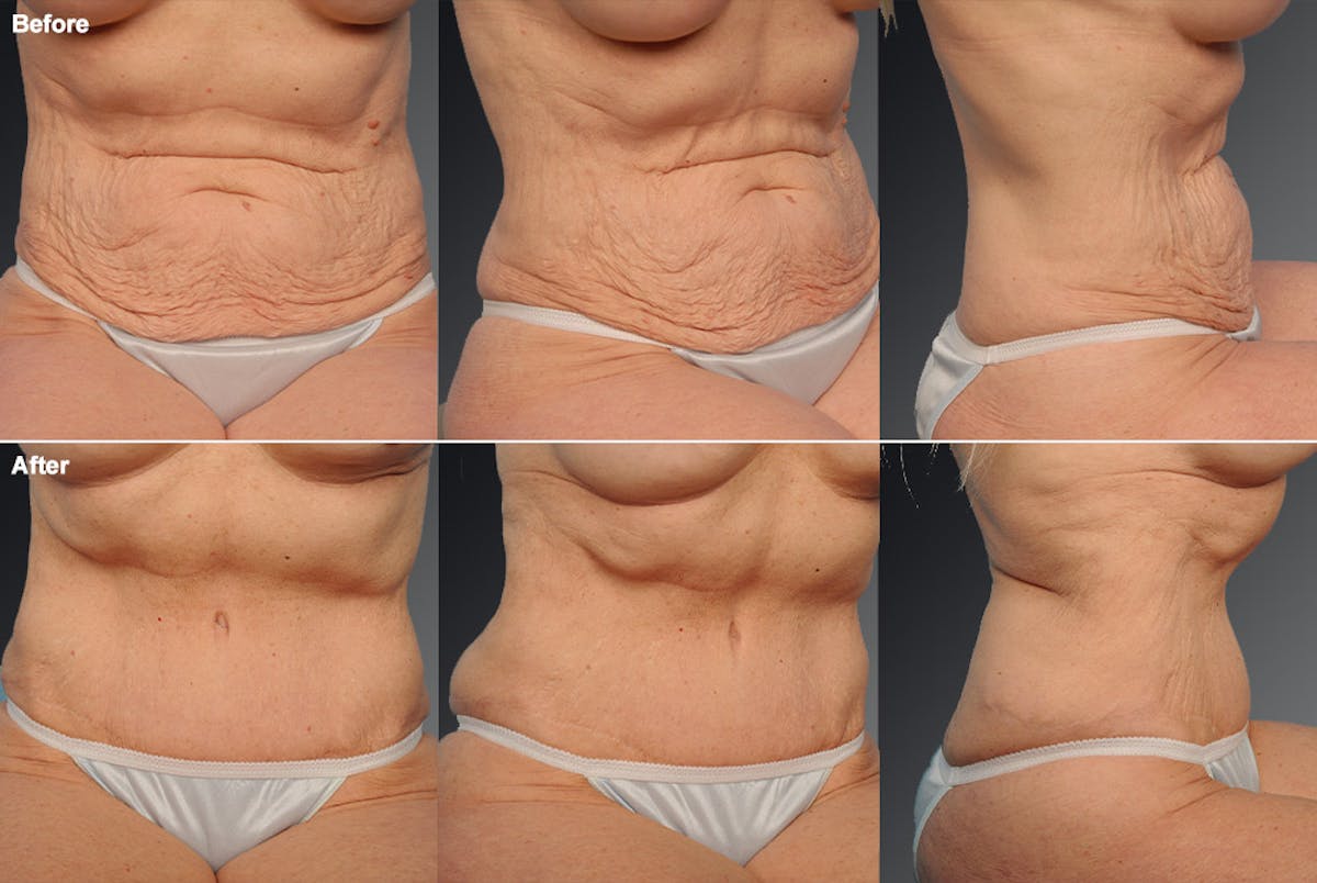 Tummy Tuck Before & After Gallery - Patient 105840739 - Image 1