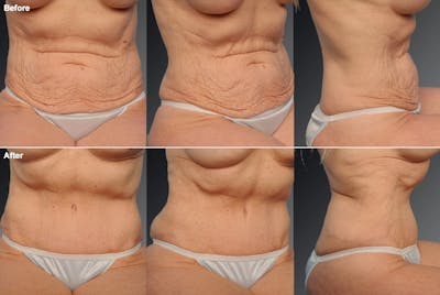 Tummy Tuck Before & After Gallery - Patient 105840739 - Image 1