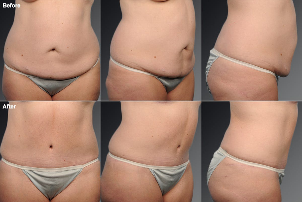 Tummy Tuck Before & After Gallery - Patient 105840740 - Image 1