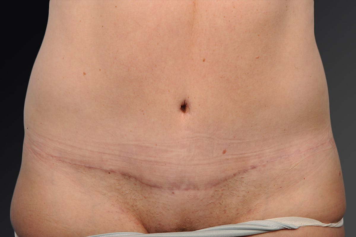 Tummy Tuck Before & After Gallery - Patient 105840741 - Image 1