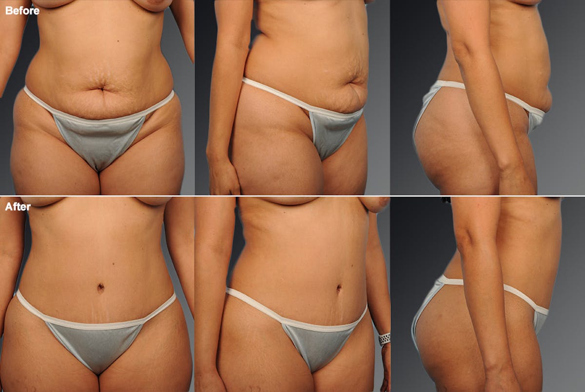 Tummy Tuck Before & After Gallery - Patient 105840742 - Image 1