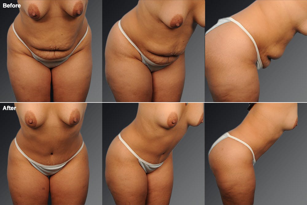 Tummy Tuck Before & After Gallery - Patient 105840745 - Image 1