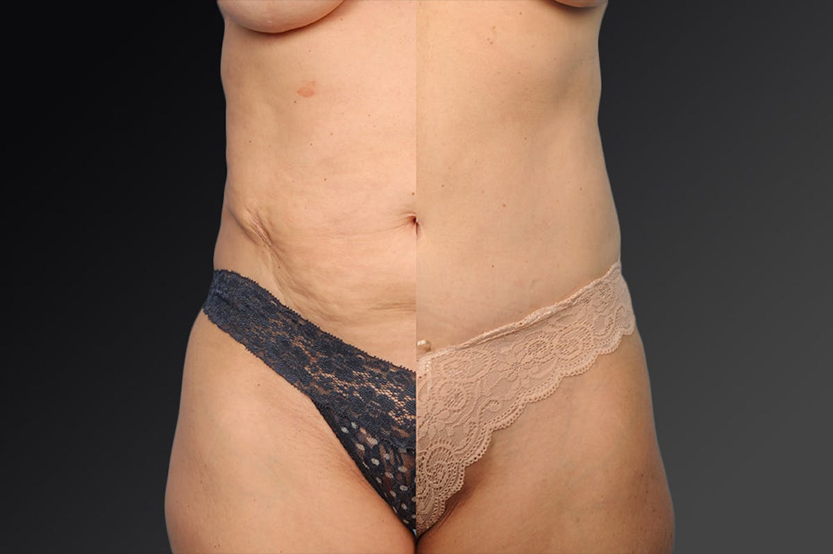 Tummy Tuck Before & After Gallery - Patient 105840746 - Image 1