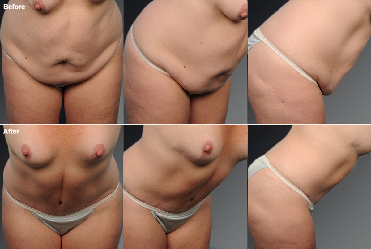 Tummy Tuck Before & After Gallery - Patient 105840747 - Image 1
