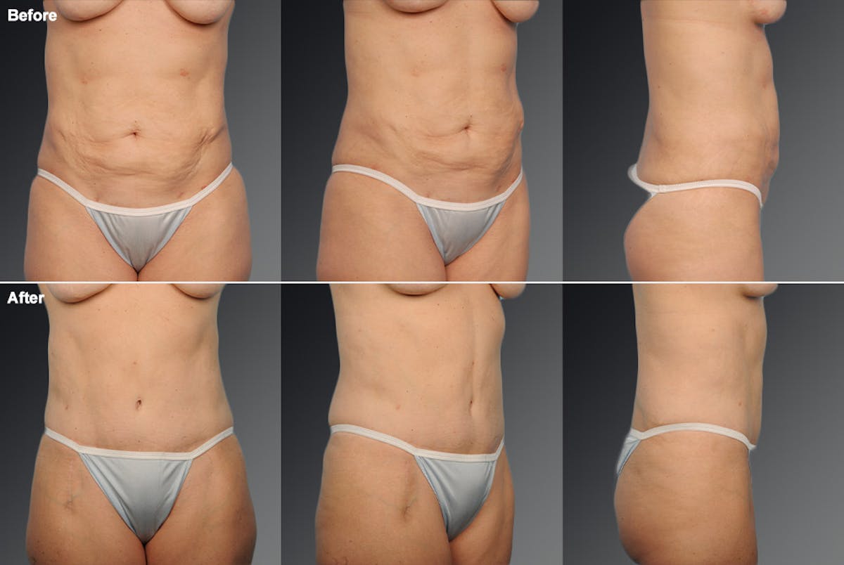 Tummy Tuck Before & After Gallery - Patient 105840748 - Image 1