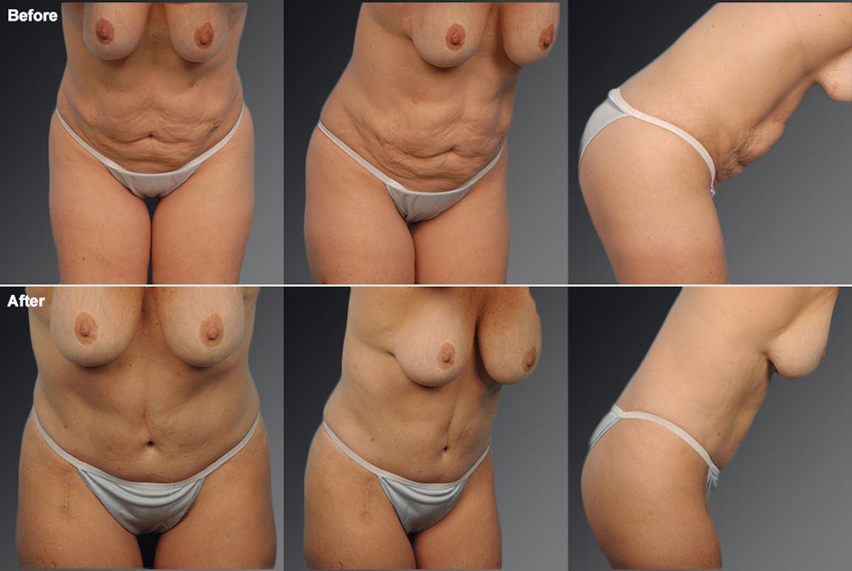 Tummy Tuck Before & After Gallery - Patient 105840749 - Image 1