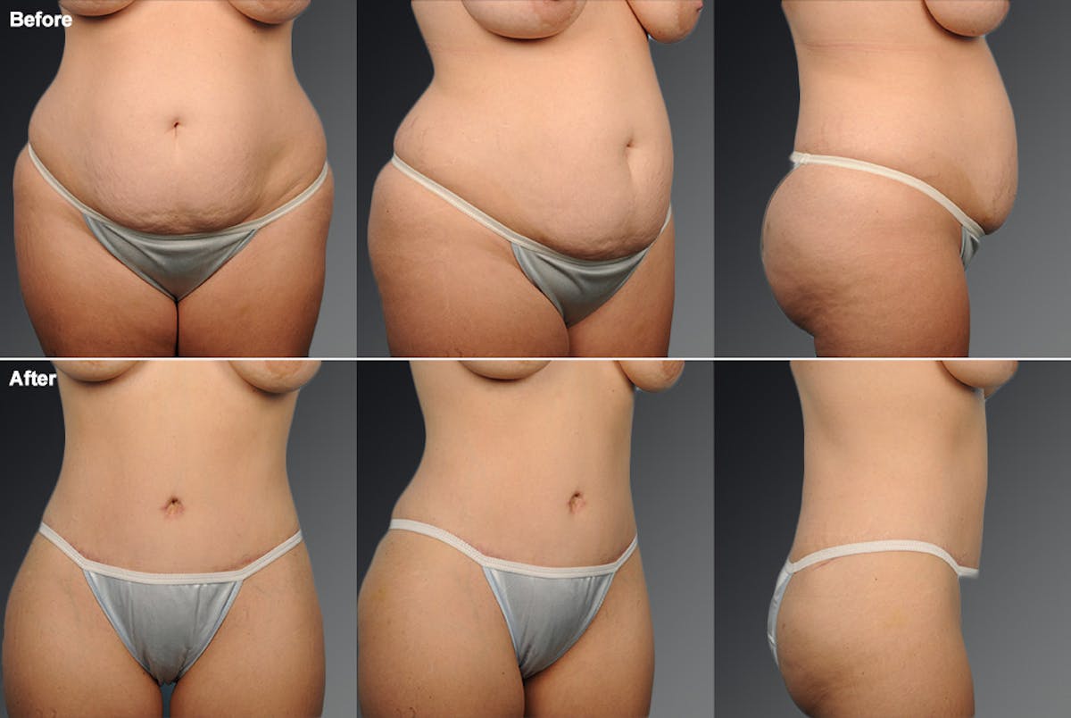 Tummy Tuck Before & After Gallery - Patient 105840750 - Image 1