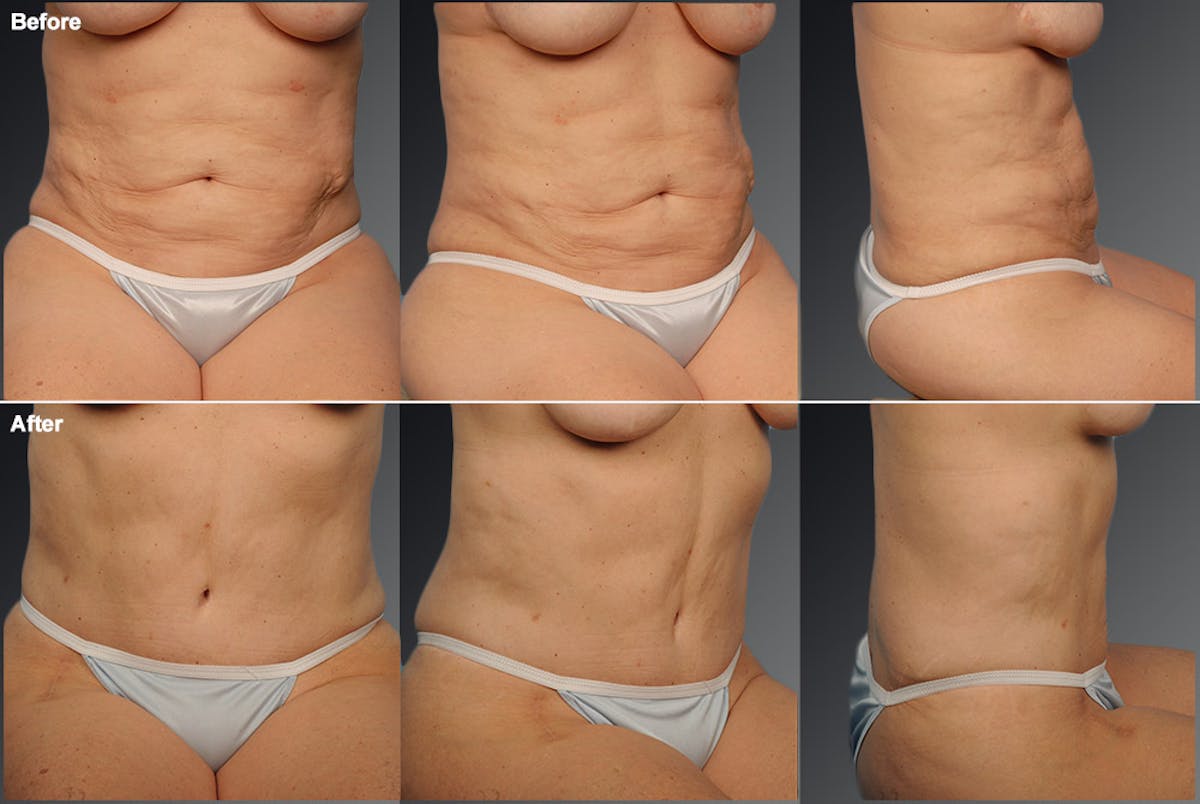 Tummy Tuck Before & After Gallery - Patient 105840751 - Image 1