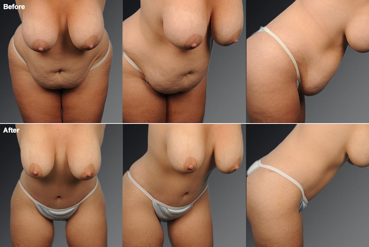 Tummy Tuck Before & After Gallery - Patient 105840752 - Image 1