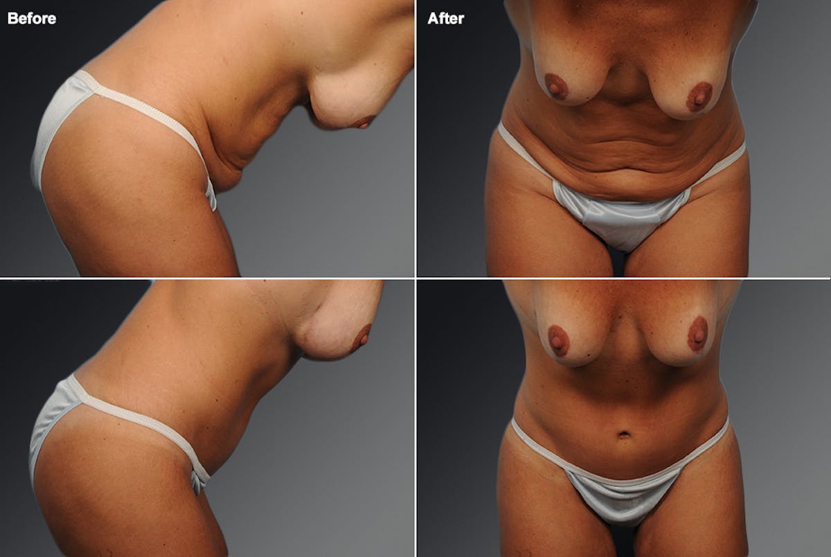 Tummy Tuck Before & After Gallery - Patient 105840753 - Image 1