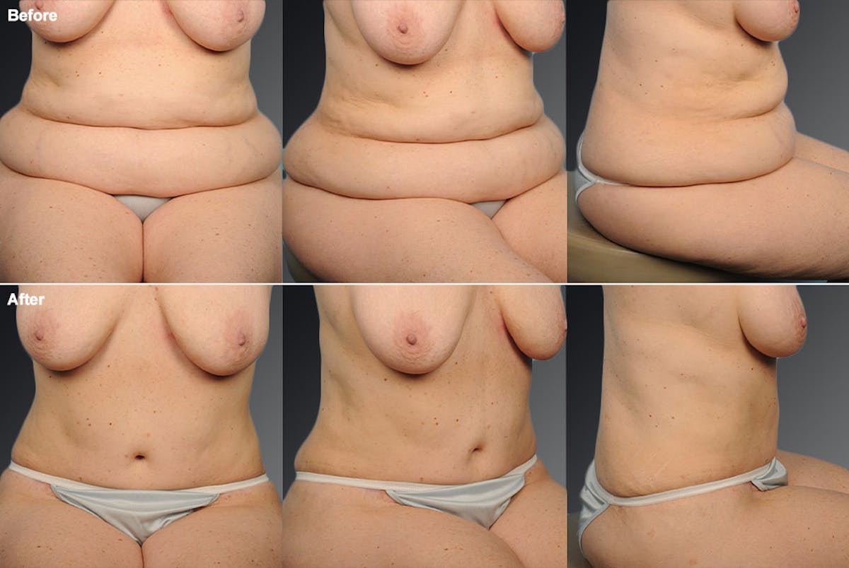 Tummy Tuck Before & After Gallery - Patient 105840754 - Image 1