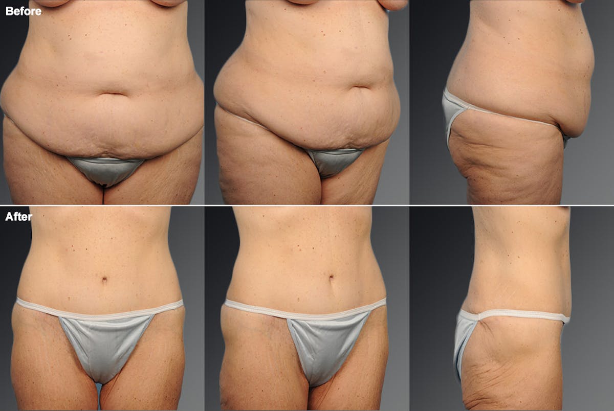 Tummy Tuck Before & After Gallery - Patient 105840755 - Image 1