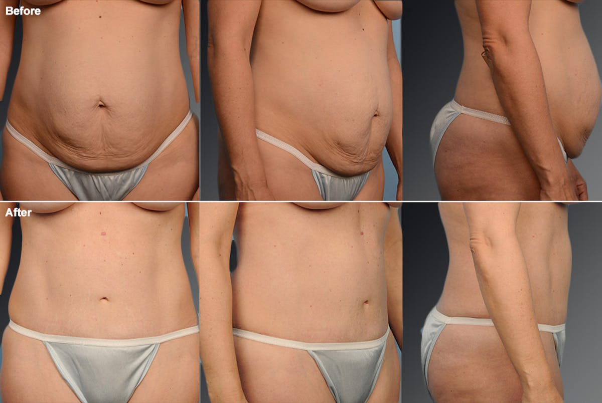 Tummy Tuck Before & After Gallery - Patient 105840757 - Image 1