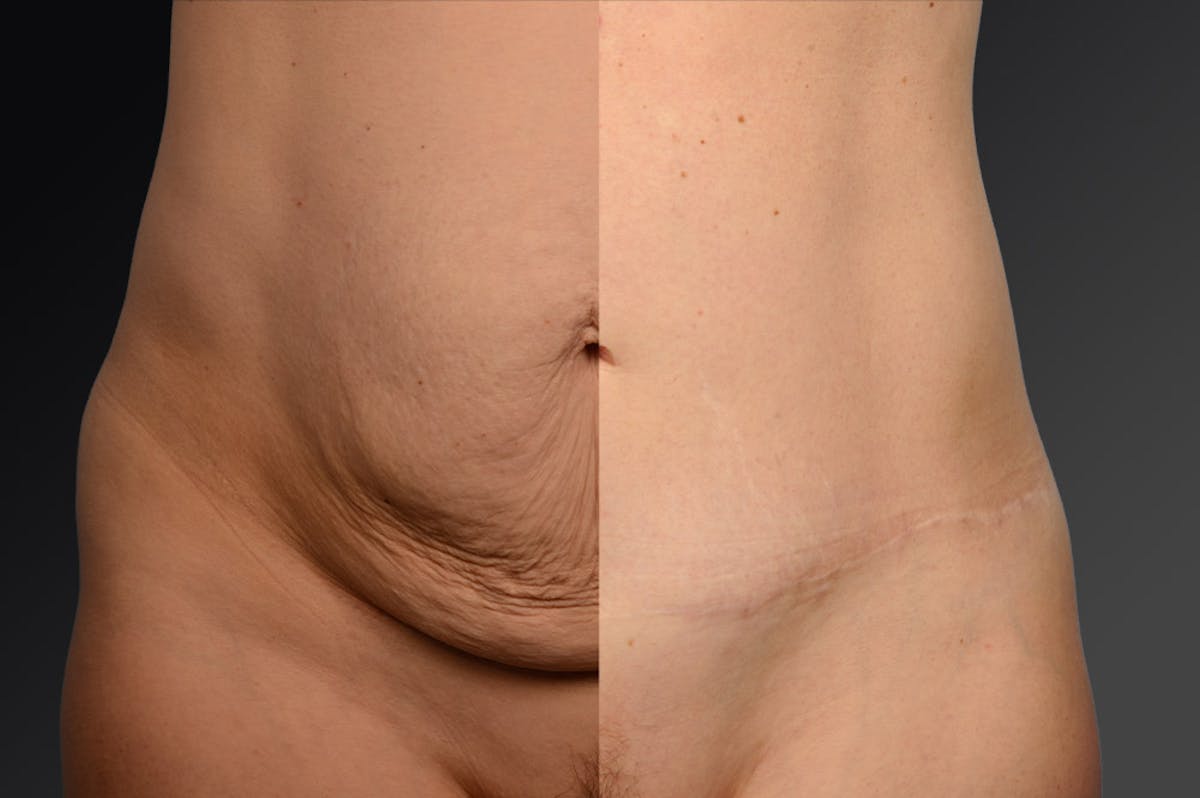 Tummy Tuck Before & After Gallery - Patient 105840759 - Image 1