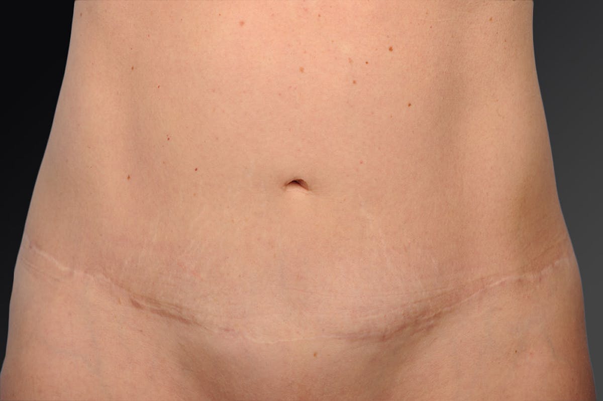 Tummy Tuck Before & After Gallery - Patient 105840760 - Image 1