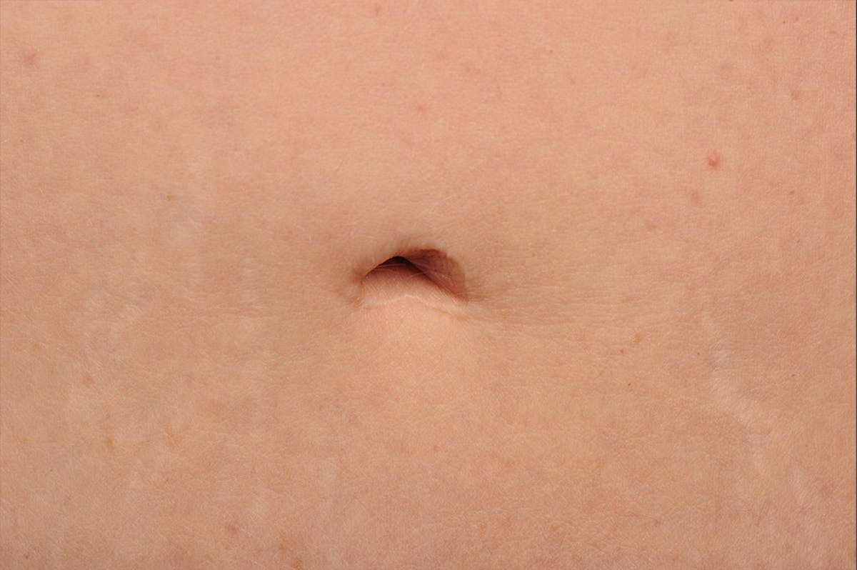 Tummy Tuck Before & After Gallery - Patient 105840761 - Image 1