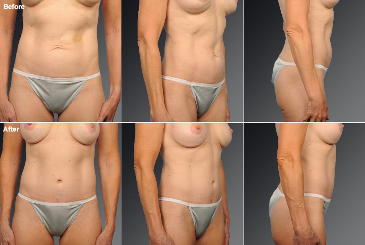 Tummy Tuck Before & After Gallery - Patient 105840762 - Image 1
