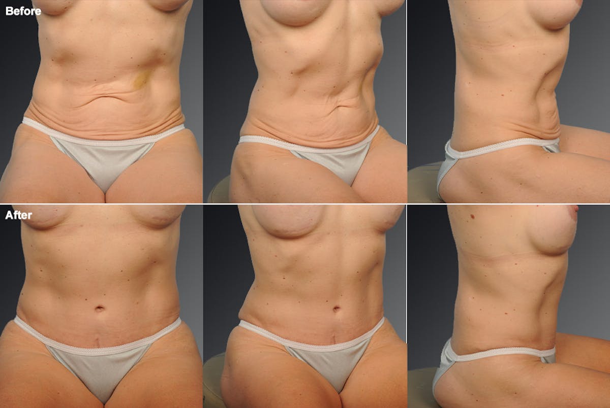 Tummy Tuck Before & After Gallery - Patient 105840764 - Image 1