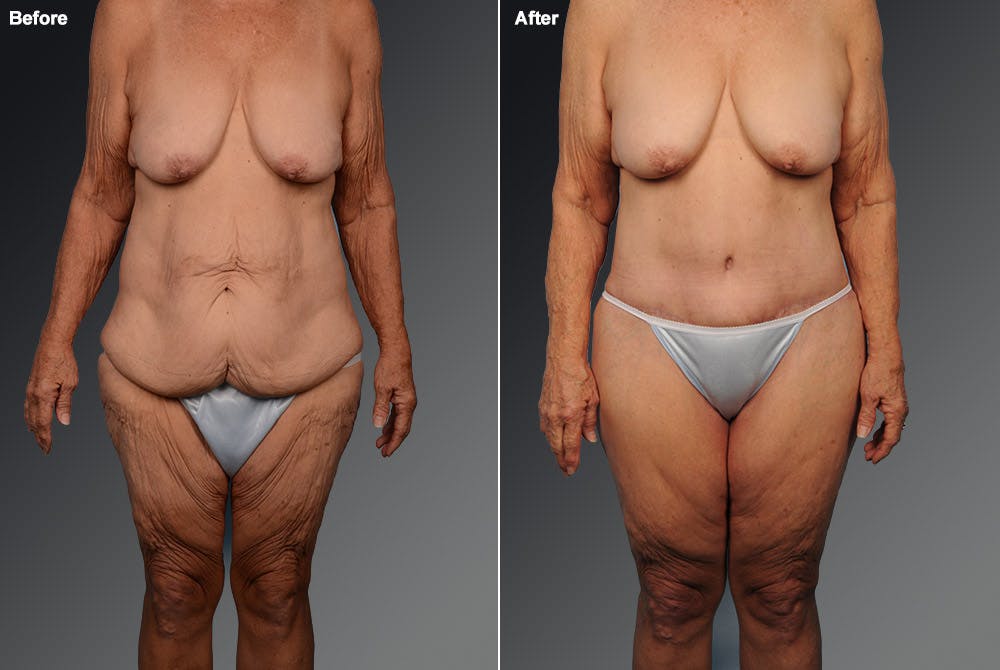 Tummy Tuck Before & After Gallery - Patient 105840765 - Image 1