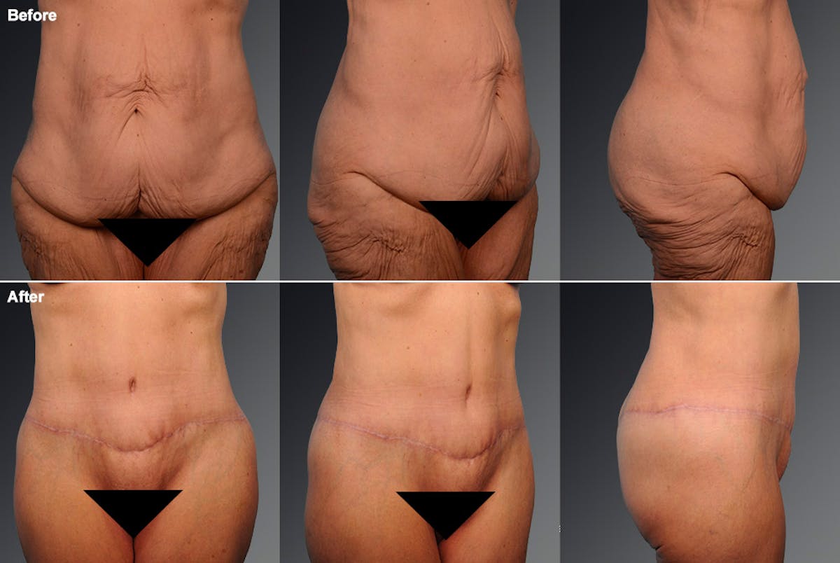 Tummy Tuck Before & After Gallery - Patient 105840766 - Image 1