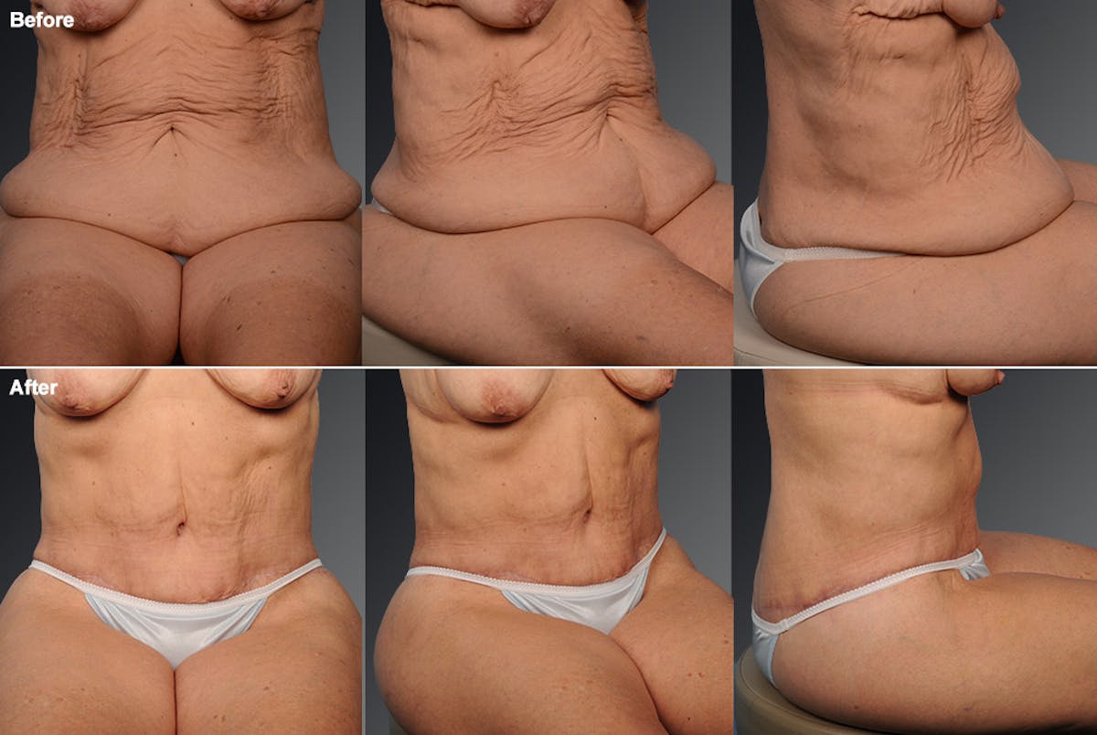 Tummy Tuck Before & After Gallery - Patient 105840767 - Image 1