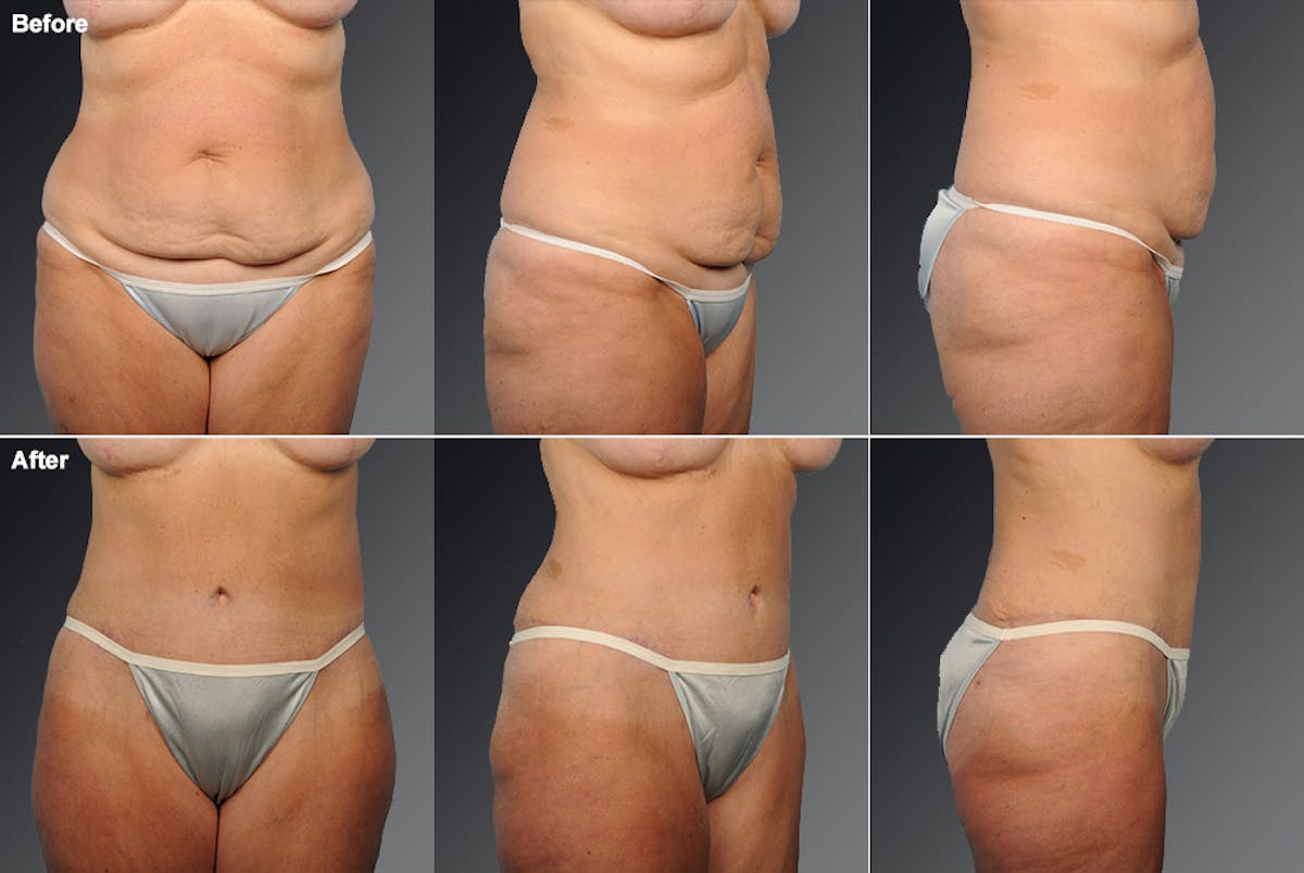 Tummy Tuck Before & After Gallery - Patient 105840768 - Image 1