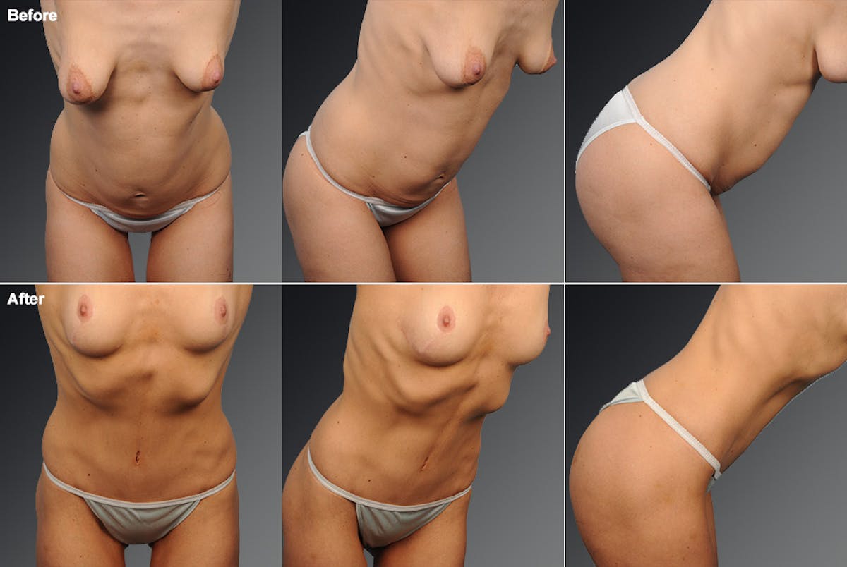 Tummy Tuck Before & After Gallery - Patient 105840770 - Image 1