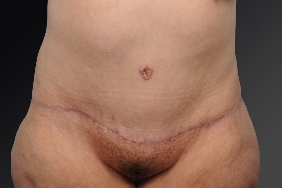Tummy Tuck Before & After Gallery - Patient 105840771 - Image 1