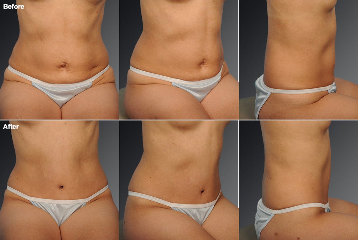 Tummy Tuck Before & After Gallery - Patient 105840773 - Image 1