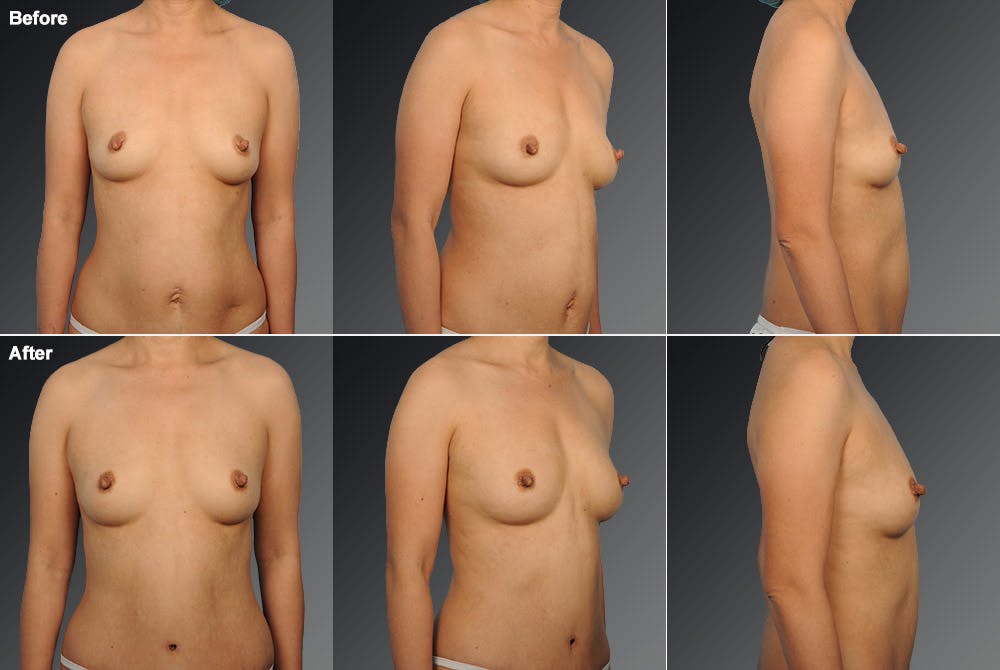 Tummy Tuck Before & After Gallery - Patient 105840774 - Image 1