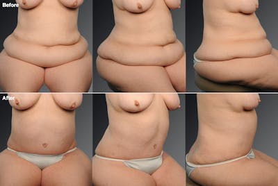 Tummy Tuck Before & After Gallery - Patient 105840775 - Image 1