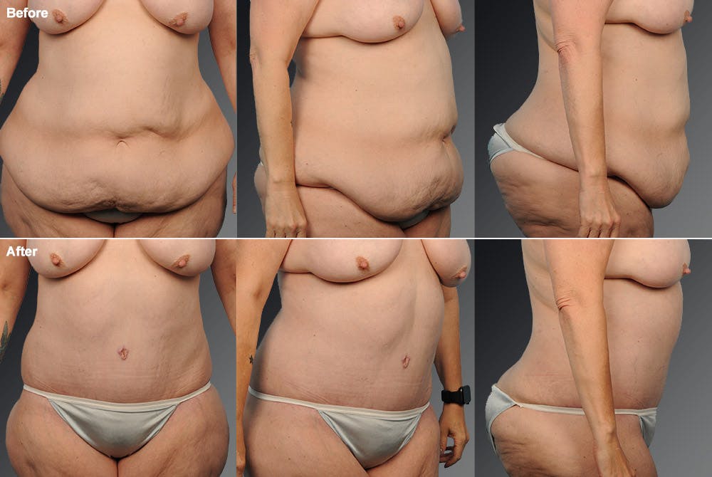 Tummy Tuck Before & After Gallery - Patient 105840776 - Image 1